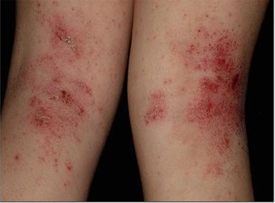 Cortar Oponerse a etc. Dermatitis atópica - Parc de Salut Mar